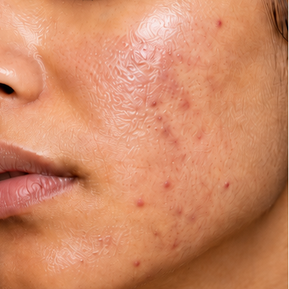 For Oily & Acne Prone Skin