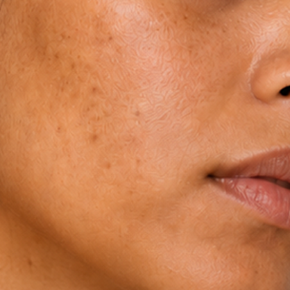 For Dull & Uneven Skin Tone